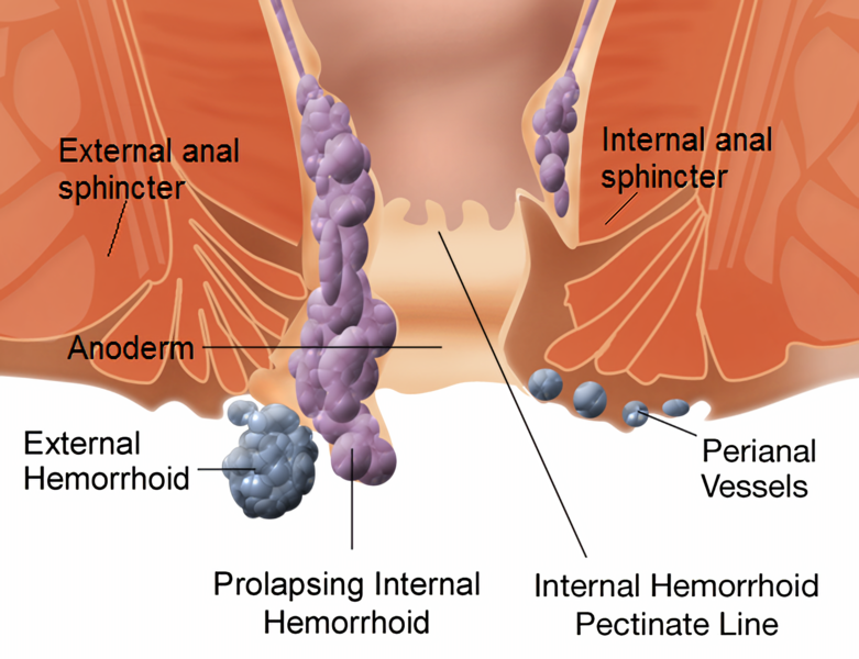 Has anyone ever gotten rid of external hemorrhoids? What was your journey?