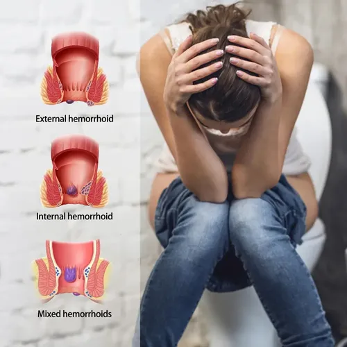 Piles (Hemorrhoids)